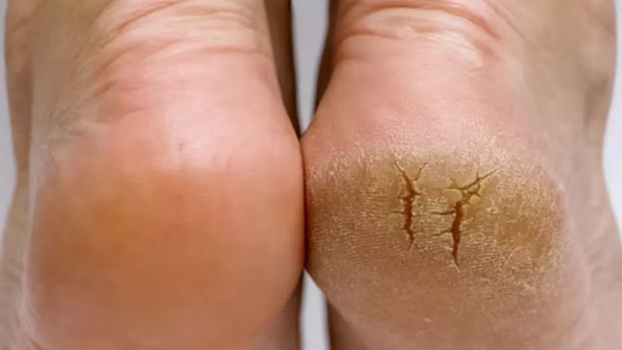 How to Manage Cracked Heels? Doctors Suggest This Simple Care