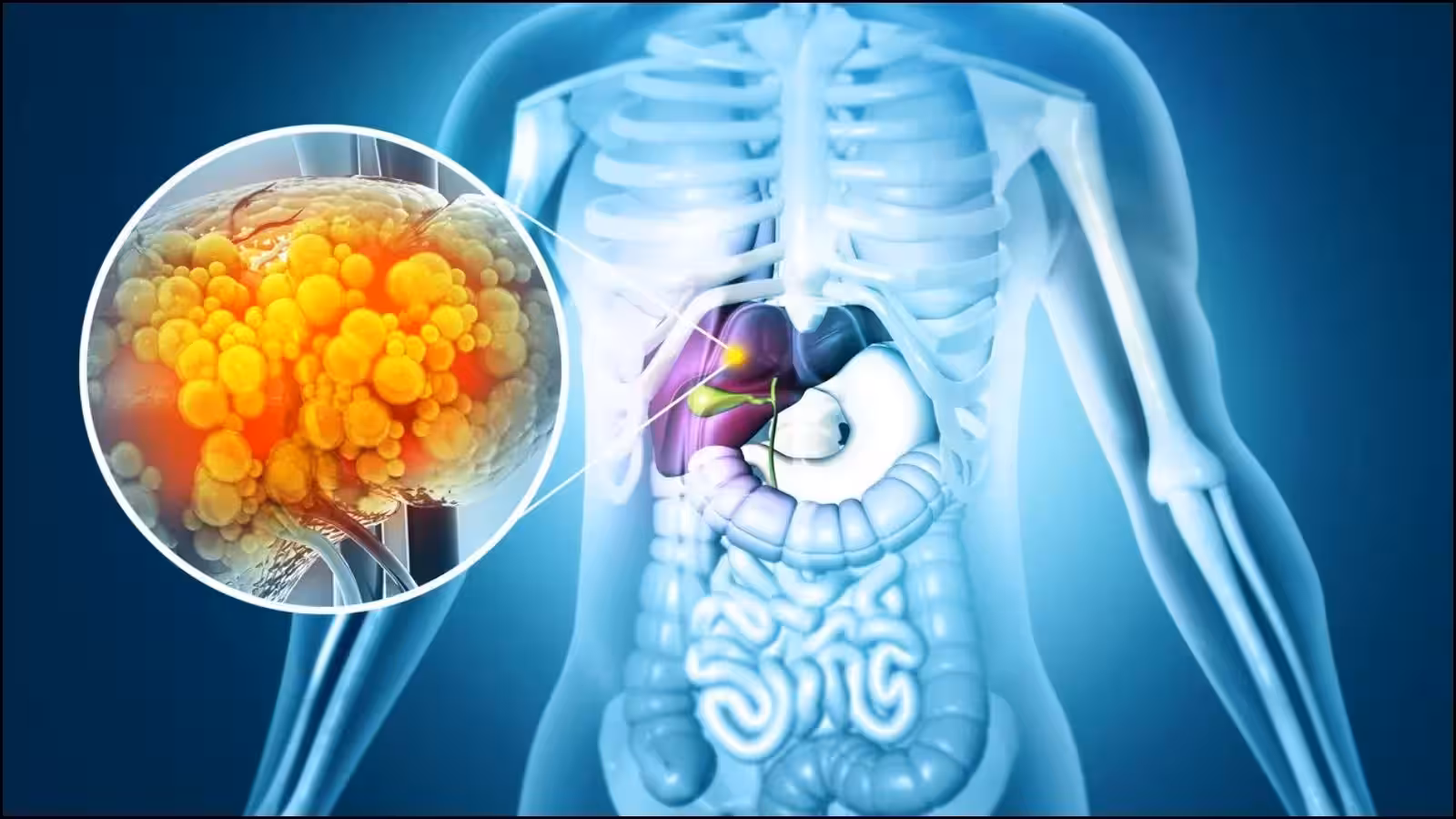 Fatty Liver vs Liver Damage.. Doctors Warn Not to Ignore These Symptoms!