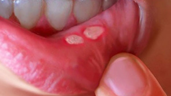 Are you suffering from mouth ulcers? These tips are for you.