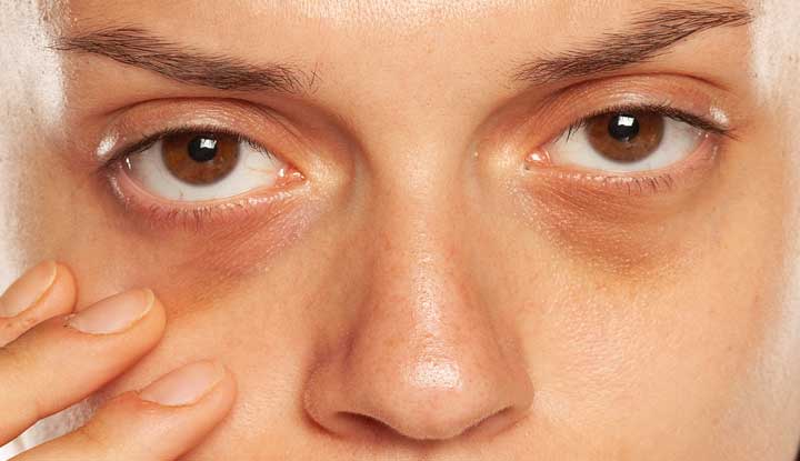 Why Do Dark Circles Appear Under the Eyes? Experts Explain the Reasons